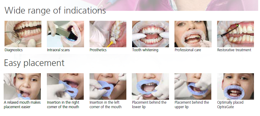 OptraGate® Lip & Cheek Retractor (pack of 10)