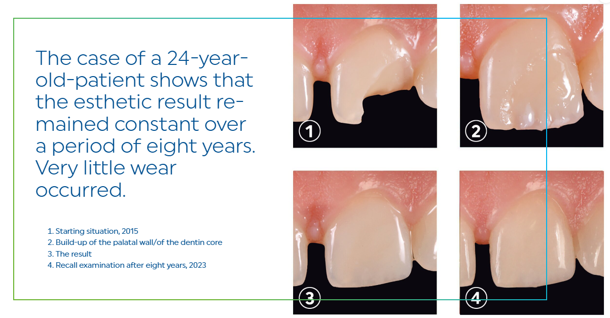 IPS Empress® Direct High Esthetic Composite
