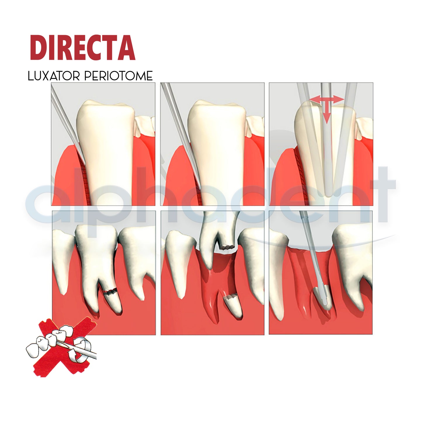 The Original Luxator® Periotome Knives